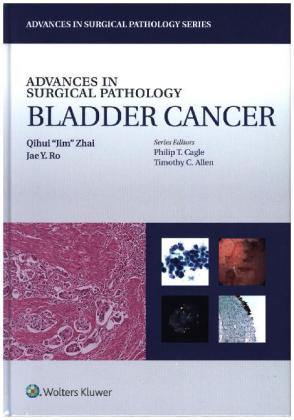 Advances in Surgical Pathology: Bladder Cancer